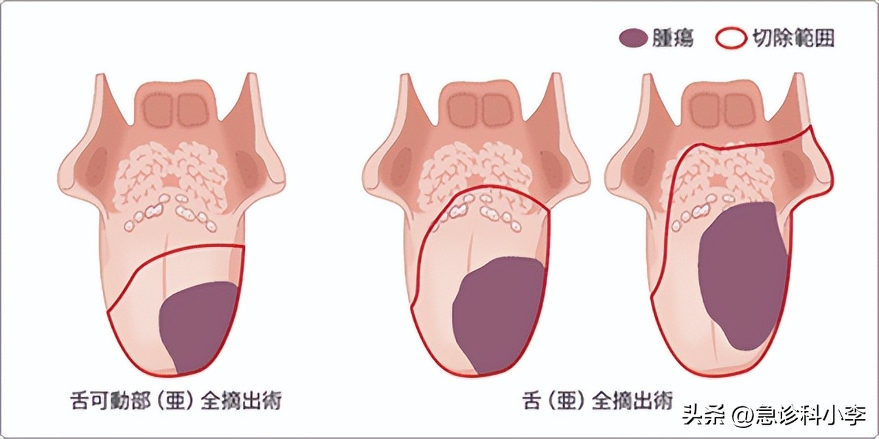 口腔癌有什么症状怎么预防,口腔癌的症状及如何预防