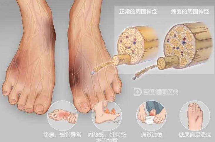 甲钴胺片治疗身体哪个地方的神经,一天吃一片甲钴胺有治疗作用吗