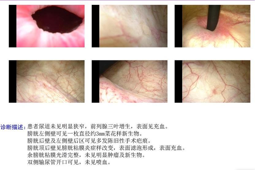 印刷燃料让56岁男子患膀胱癌——钬激光成功拯救他