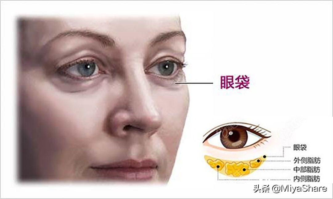 拖了一年的手术,眼袋手术5年后的感受