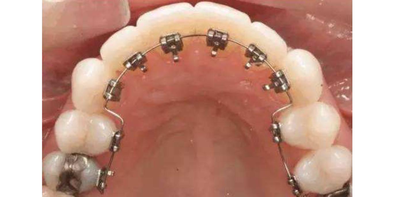 传统牙套和隐形牙套区别,牙套自锁和非自锁区别