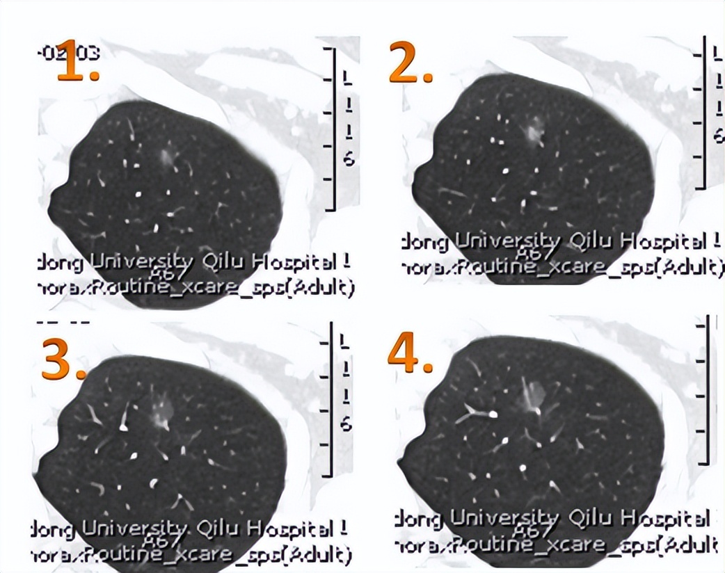 70%磨玻璃肺结节无需着急手术,磨玻璃结节5mm医生说原位癌