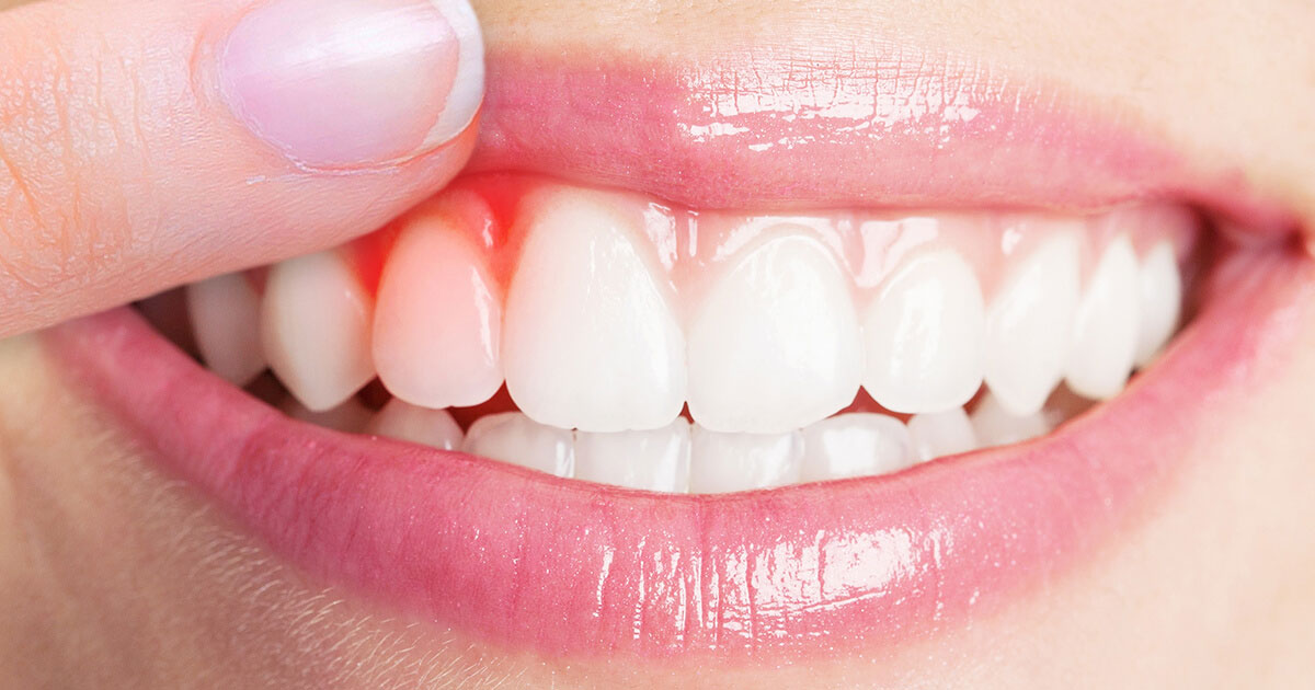 牙龈肿痛发炎吃的药,牙龈肿痛发炎化脓