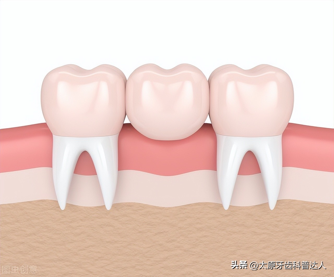 牙齿多颗缺失是种植好还是镶牙好,牙齿大面积缺失怎么镶牙