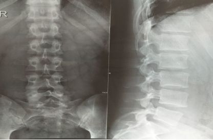 中医治疗腰腿痛针灸费用,王纪强针灸治坐骨神经痛全部视频