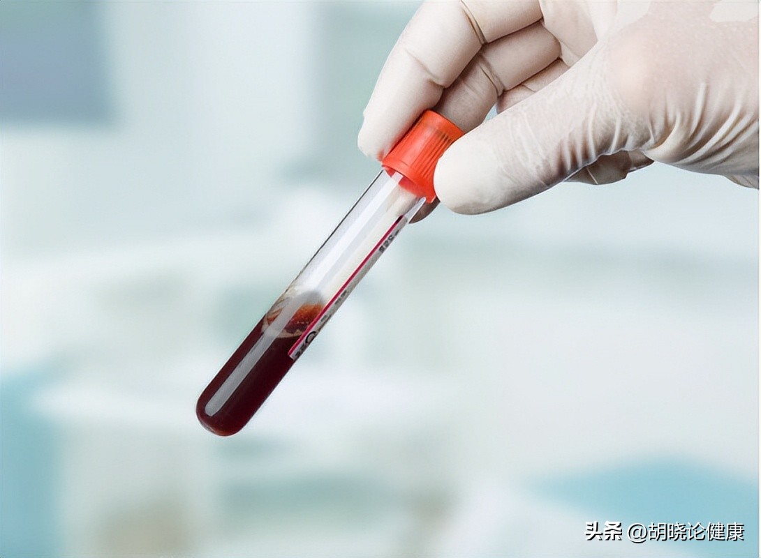 狼疮肾炎补体c4低是狼疮复发吗,狼疮性肾炎诊断的特异性抗体指标