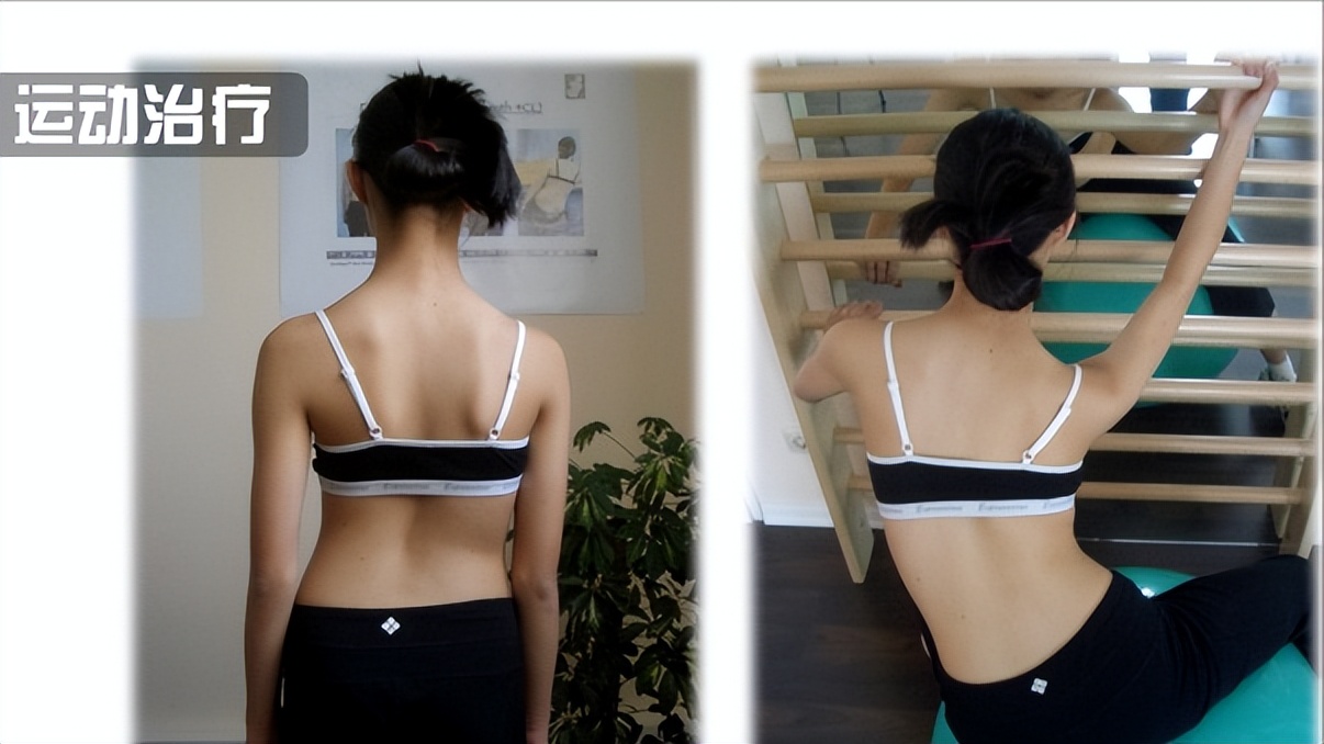 针灸治疗脊柱侧弯的最好方法,10岁小孩脊柱侧弯怎样治疗