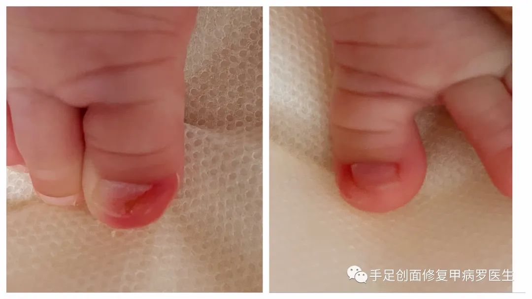宝宝脚趾甲有脓了怎么处理,给宝宝剪指甲流脓怎么办