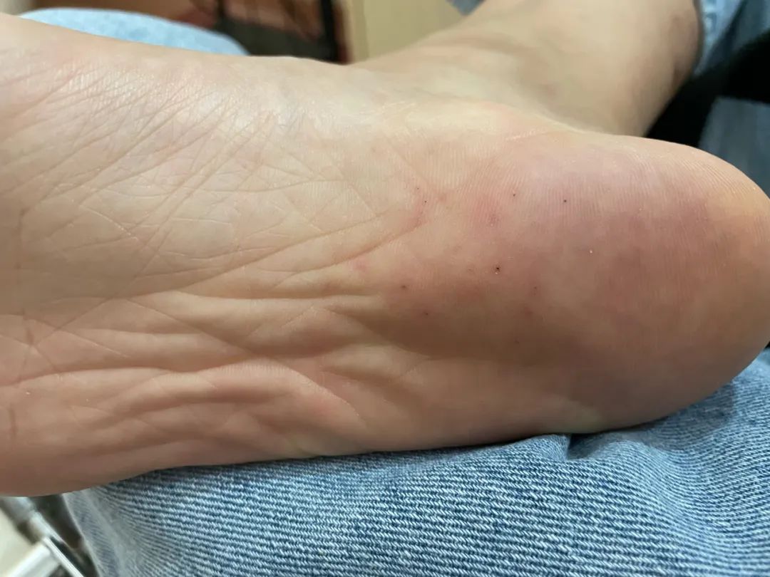 赶海被海胆刺到,赶海被海葵蜇伤