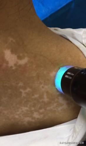 银屑病和白癜风用的光疗有区别吗,白癜风治疗308准分子光好使吗