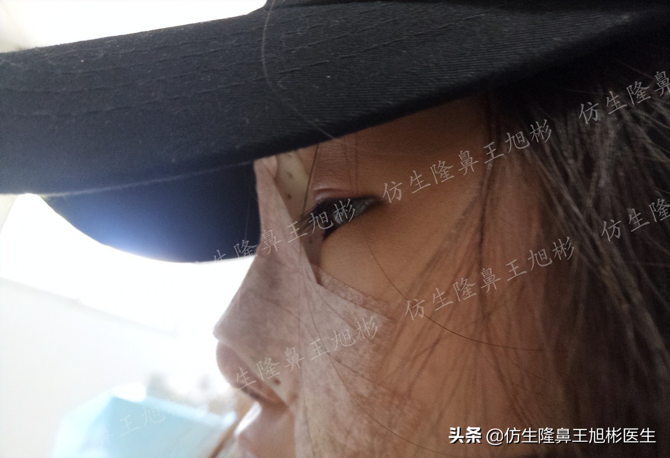 山根低鼻头大隆鼻,鼻根很低的隆鼻后的效果