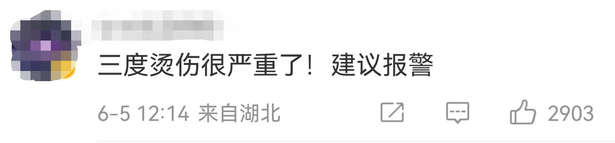 2岁孩子烫伤9天才送医！遇到烧烫伤我们应该如何处理