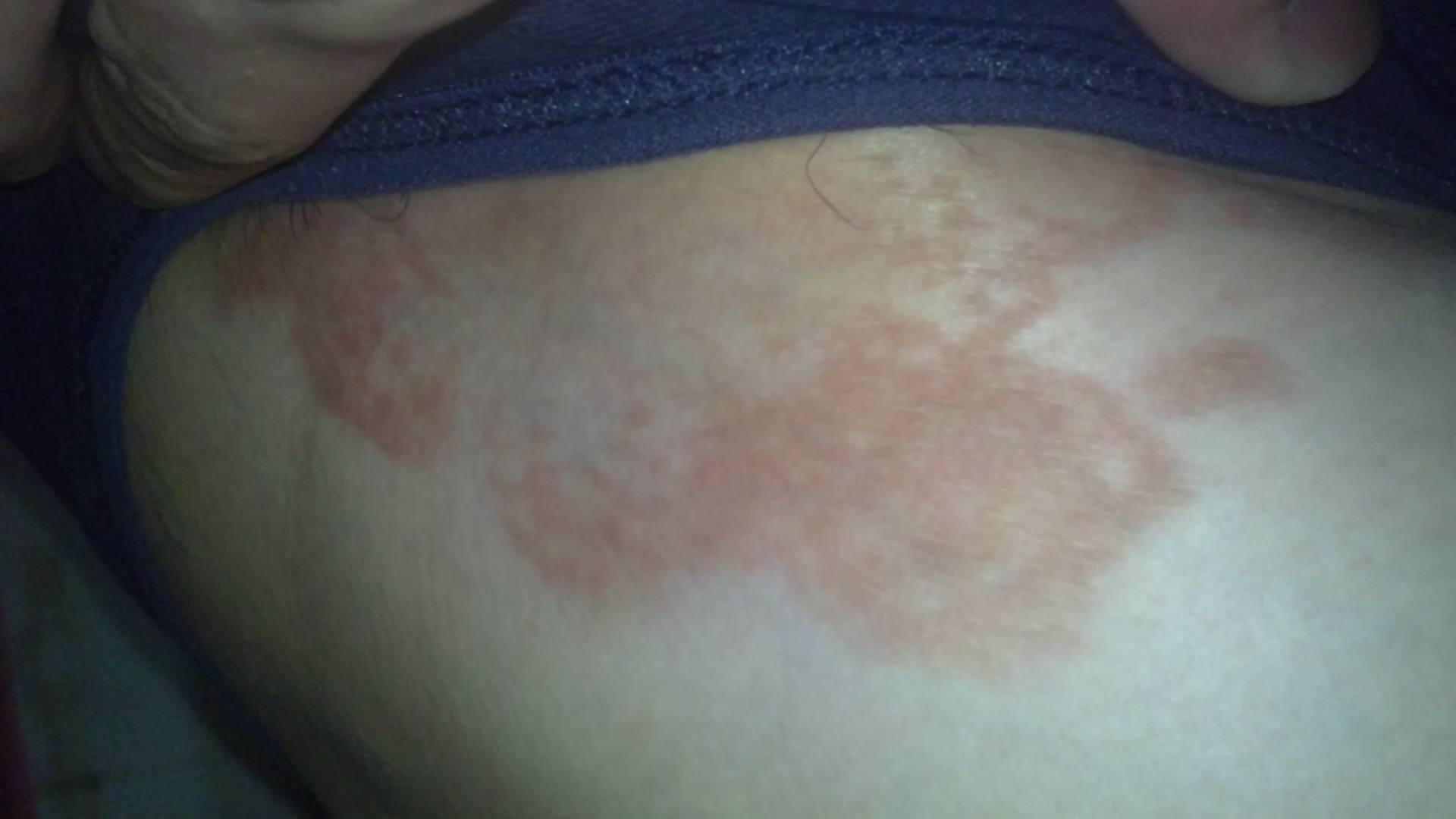 别把股癣当做“性病”！两者都有哪些区别，如何治疗？医生教你