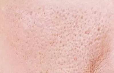 为什么会毛孔粗大长粉刺,为什么会毛孔粗大油光满面