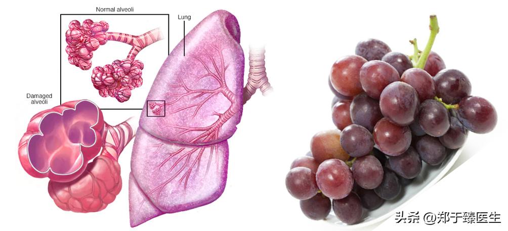 新冠病毒是如何损坏肺功能的,新冠病毒引起的肺部炎症怎么办