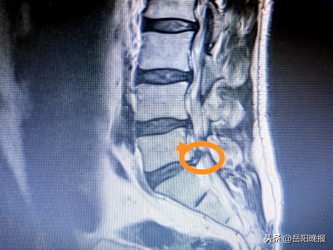 腰椎间盘突出3个方法标本兼治,张志远中医诊所治腰椎间盘突出