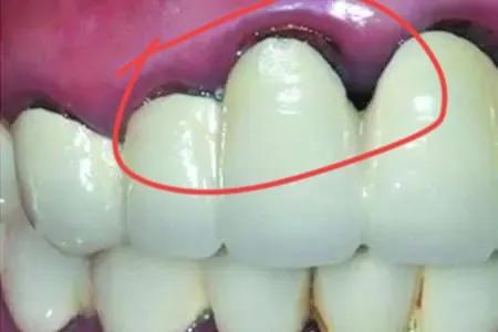 烤瓷牙一定要做桩吗,烤瓷牙用哪种牙套好