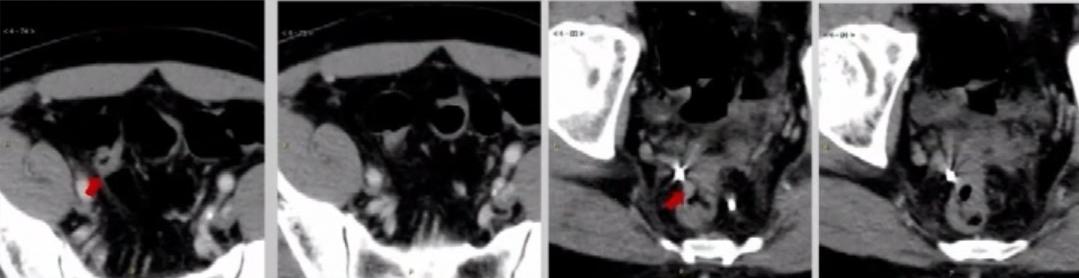 多原发癌症转移,多原发直肠癌