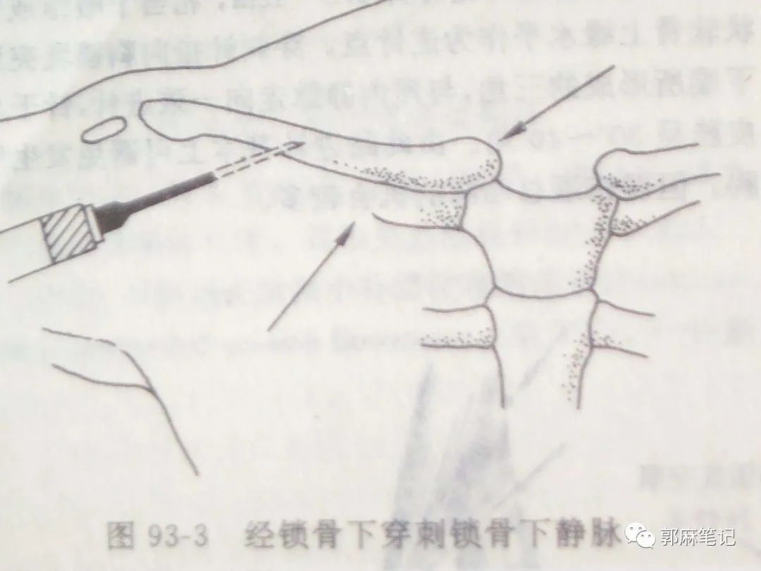 中心静脉穿刺置管术ppt免费,中心静脉置管的护理ppt
