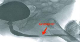 排尿困难是哪里出了问题,男性尿道狭窄排尿有什么症状