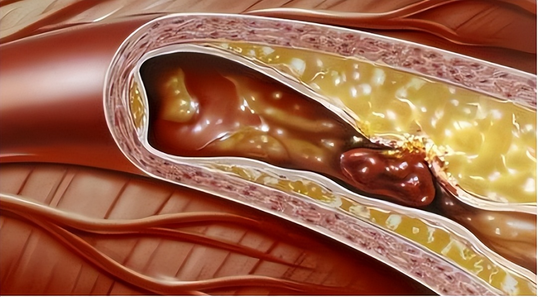 肾结石不能吃鸡蛋吗需要注意什么,肾结石鸡蛋不能吃还能吃什么
