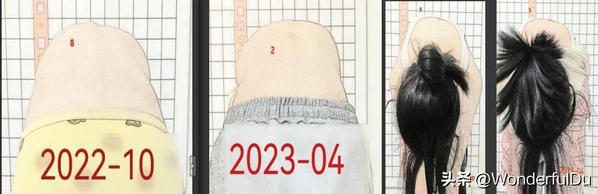 脊柱侧弯矫正改善,脊柱侧弯达到多少度需要矫正