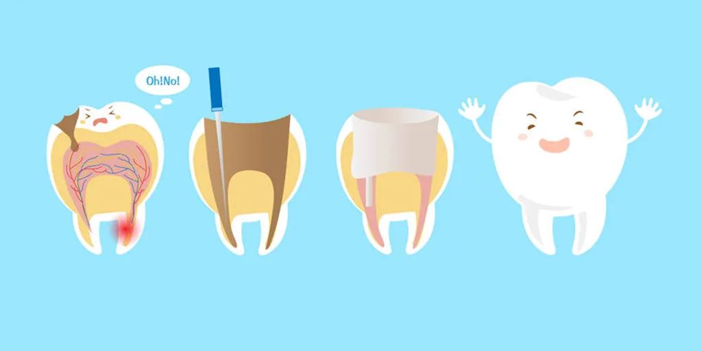 根管治疗后牙齿寿命会变短吗,门牙根管治疗后牙齿的寿命