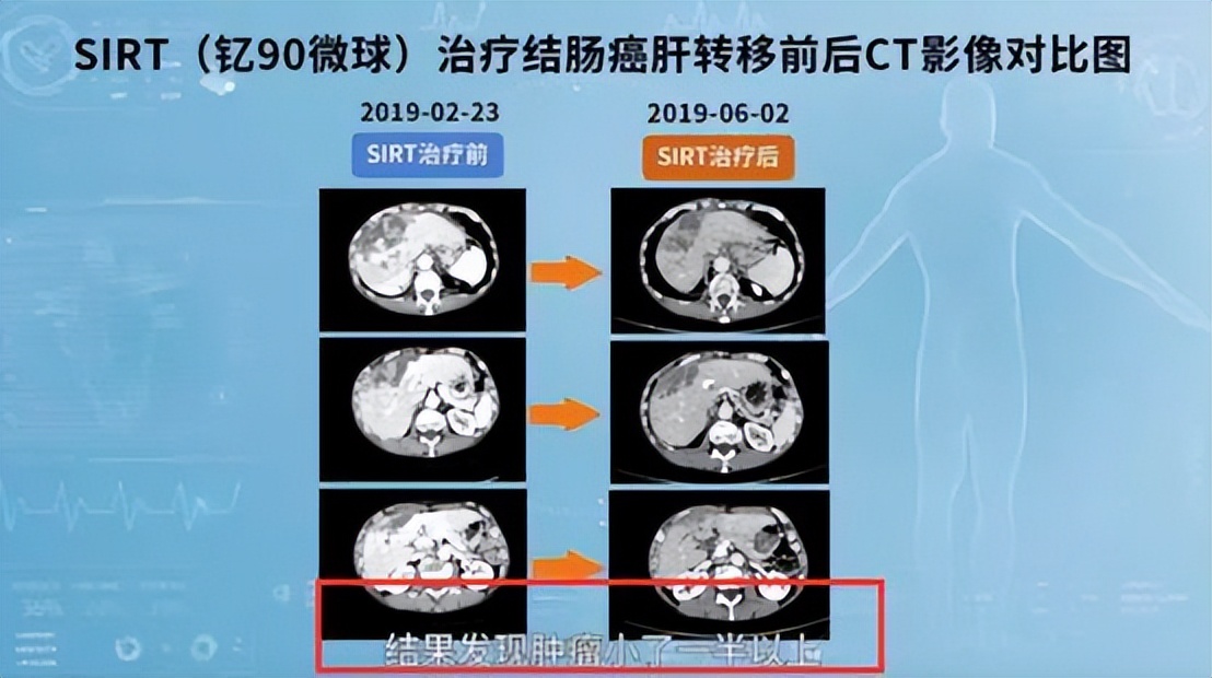 普通人也能用得起吗？抗癌新药钇90在我国上市，中晚期也有望治愈