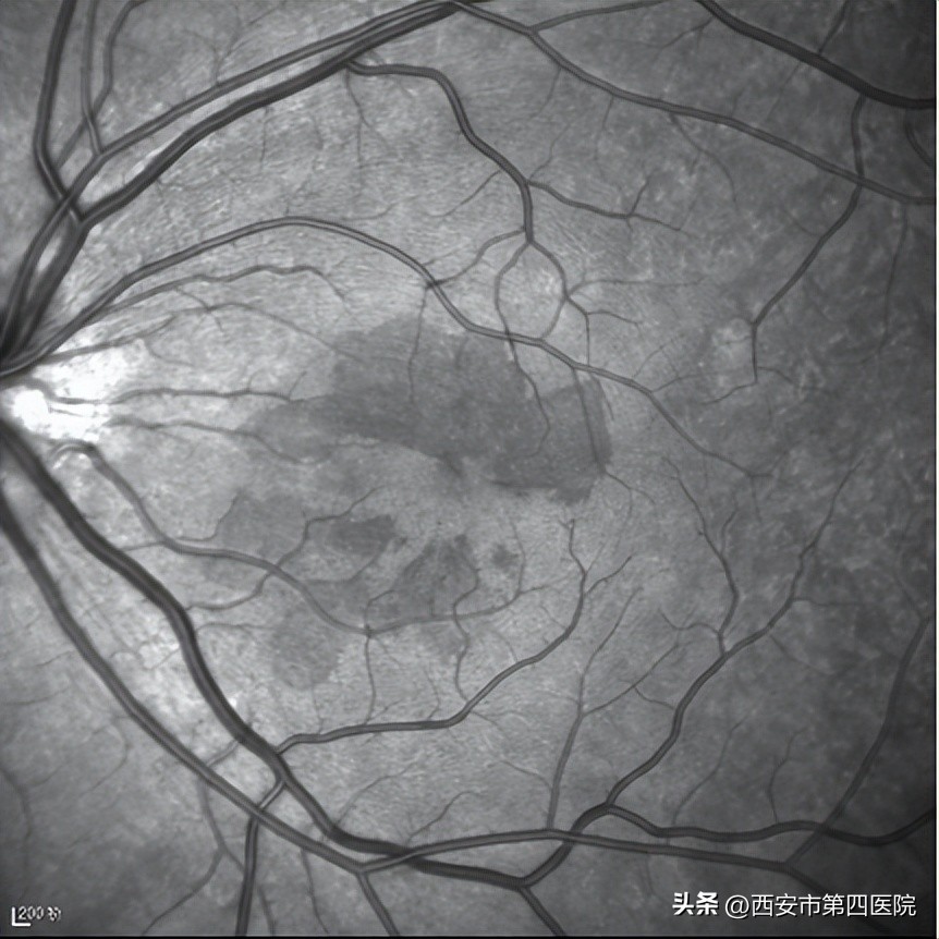 #新冠防疫手册#33岁女士“阳康”后视力下降、模糊、黑影……
