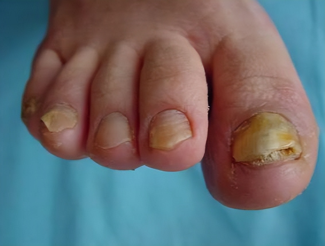 真菌性皮肤病—甲真菌病(灰指甲)