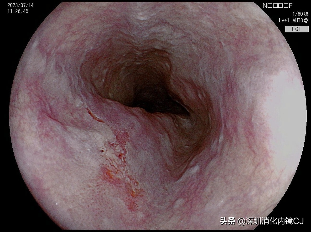 69岁及时发现食管癌，内镜下微创根治，避免了外科开胸手术