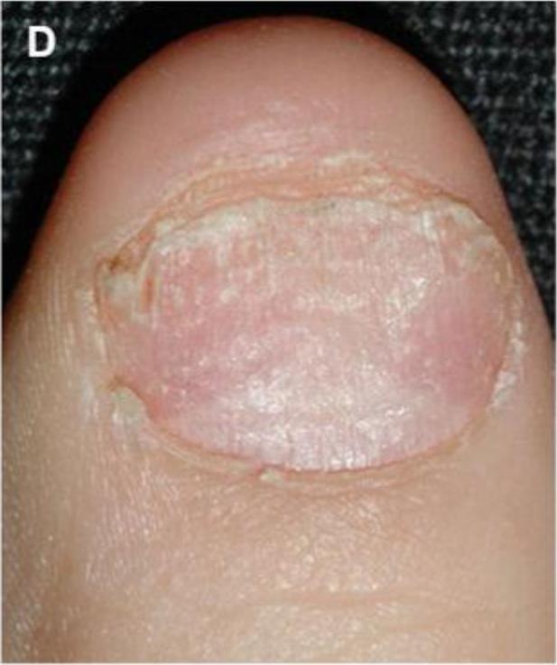 指甲有竖纹有月牙怎么回事,指甲月牙不是很白怎么回事