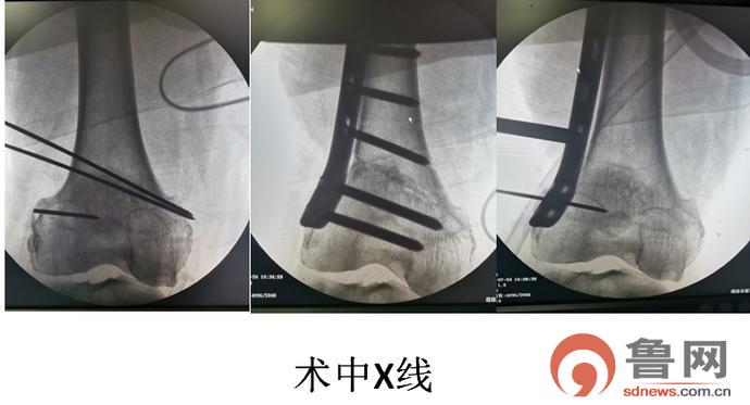 菏泽市第三人民医院骨外科通过DFO术成功治愈一患者