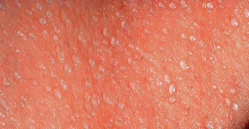 儿童生疹子哪里红点多,怎么区分孩子起的各种疹子