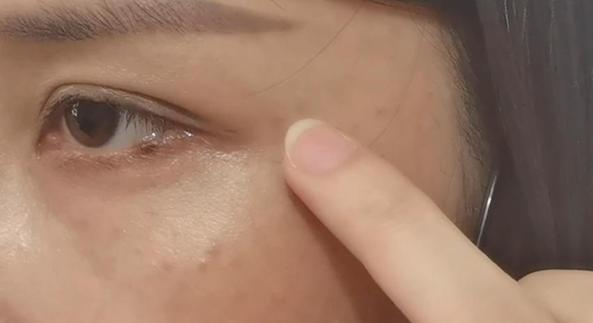 打除皱眼睛失明了,无证美容院打除皱针造成身体伤害