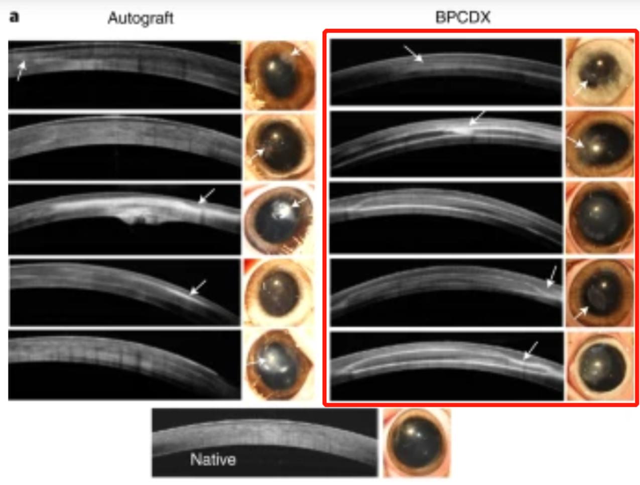 角膜移植方法大全,用猪皮提取眼角膜