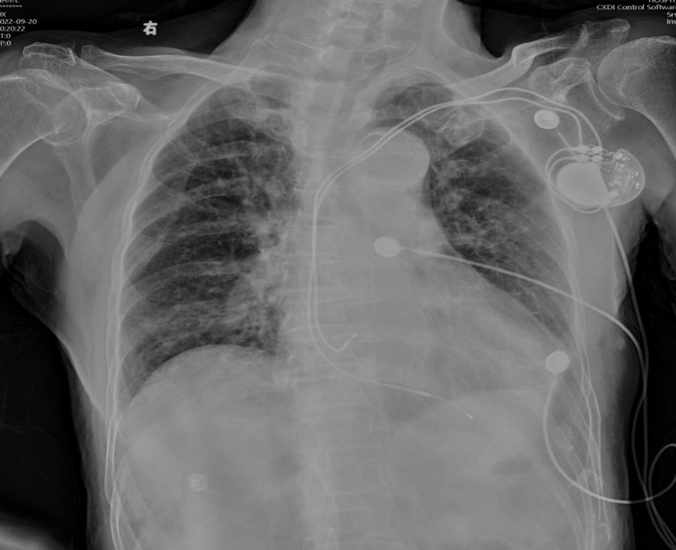 74岁老人误吞带钩假牙,老人误吞假牙怎么取出