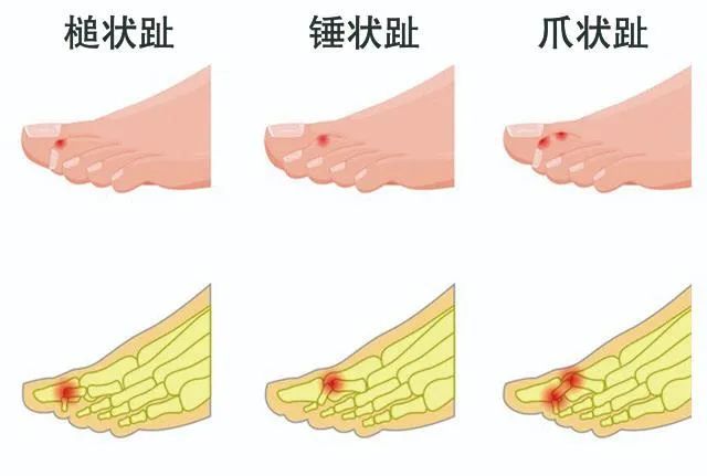 脚长得有点畸形,脚长歪了的图片