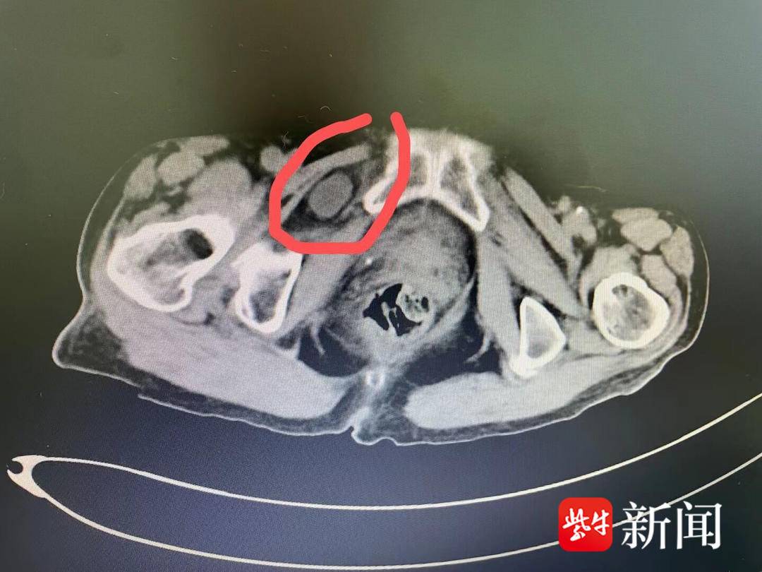 肠子罕见病,肠子掉到大腿根部