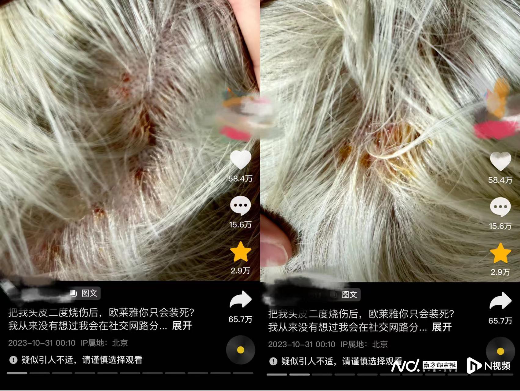 染发烧伤头皮欧莱雅,欧莱雅漂染头发烧伤